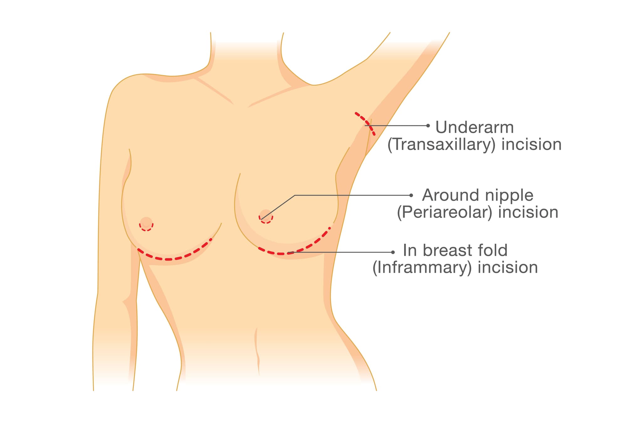 Breast augmentation incision options: underarm transaxillary, around nipple periareolar, and breast fold inframammary