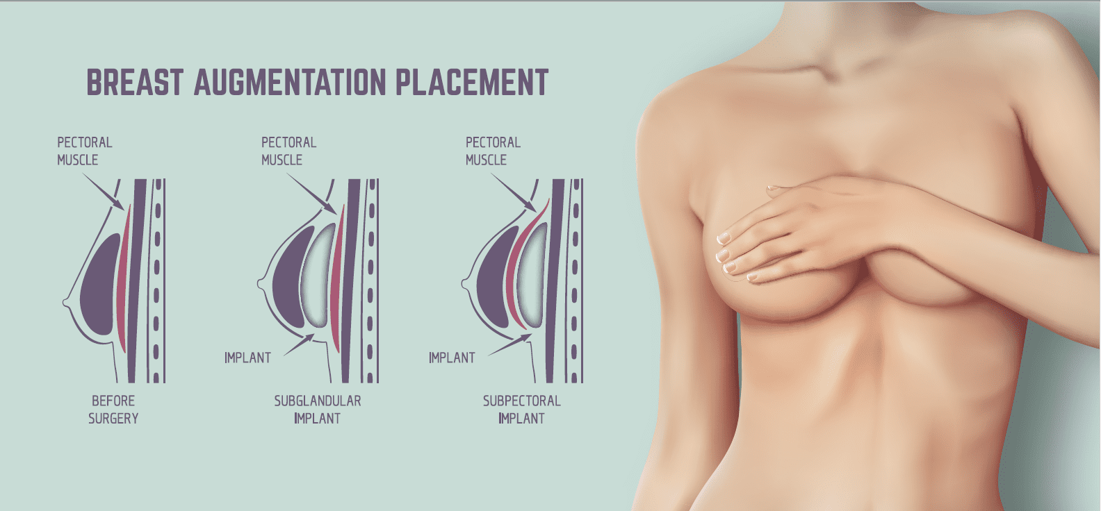 Breast augmentation placement diagram showing pectoral muscle, subglandular implant, and subpectoral implant positions