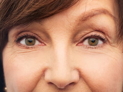 Eyelid Surgery