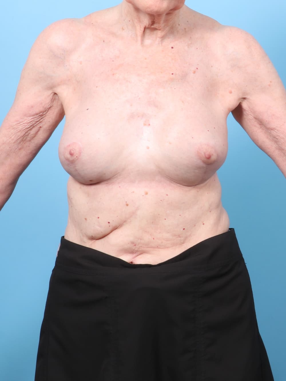 Breast Implant Revision case #9008 after, image 1