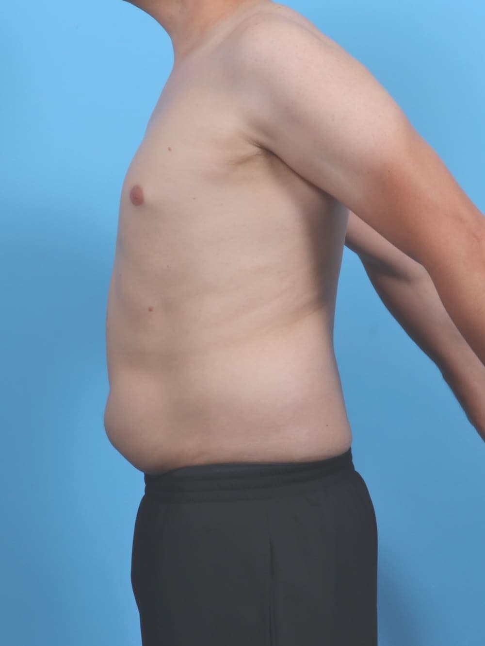 Liposuction case #5992 before, image 3