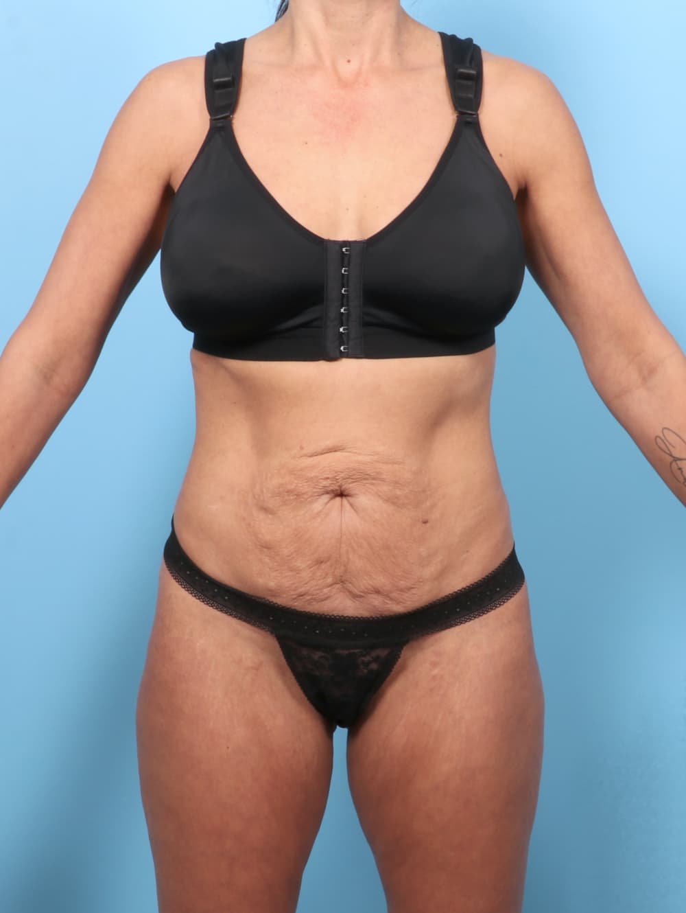 Tummy Tuck case #9023 before, image 1