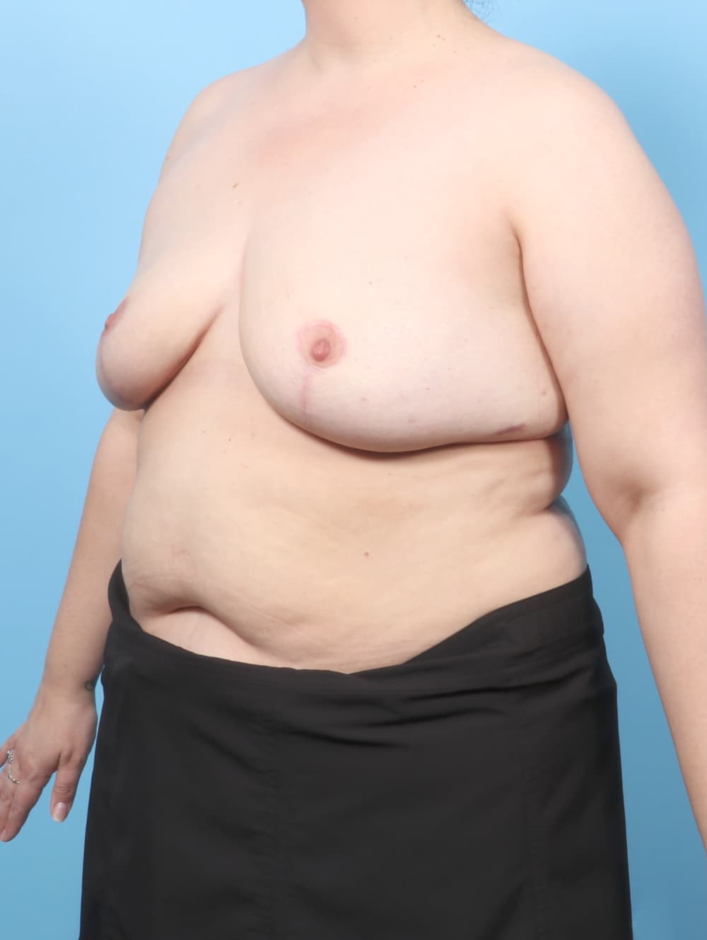 Breast Implant Removal with Lift case #9002 after, image 3