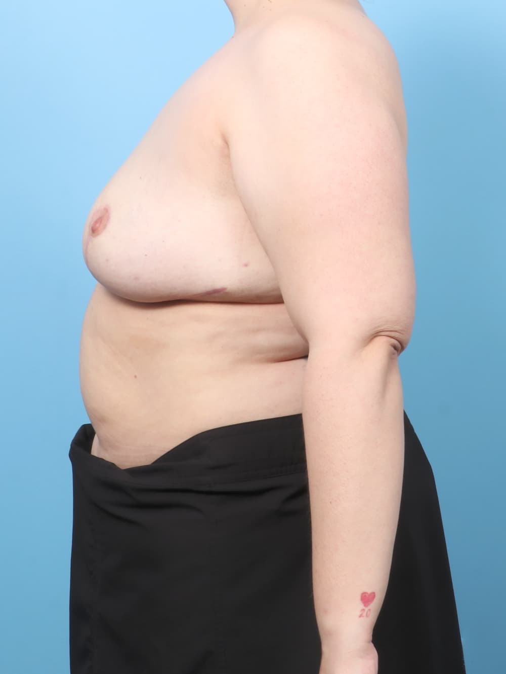 Breast Implant Removal with Lift case #9002 after, image 2