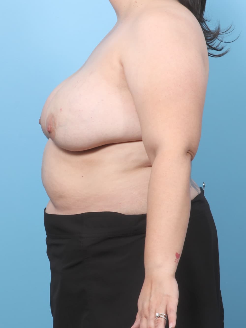 Breast Implant Removal with Lift case #9002 before, image 2