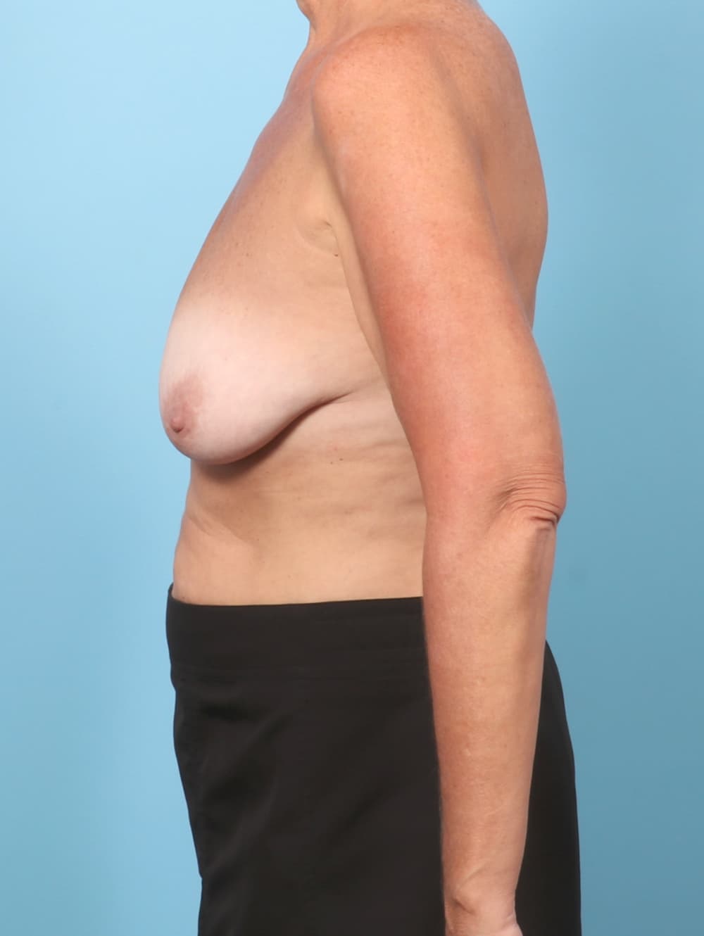 Breast Lift with Implants case #8997 before, image 3