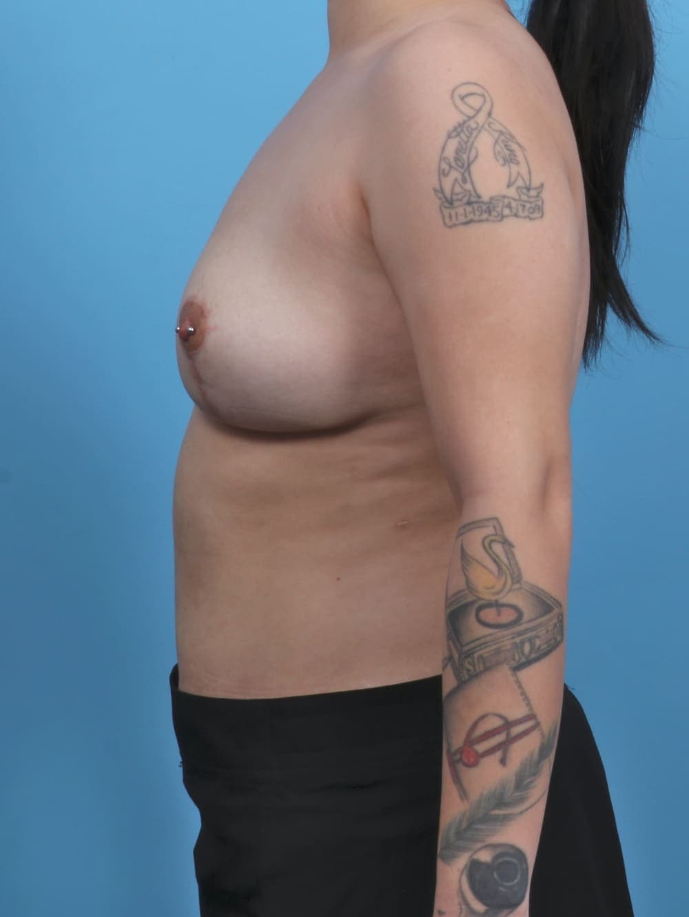 Breast Implant Revision case #4794 after, image 3