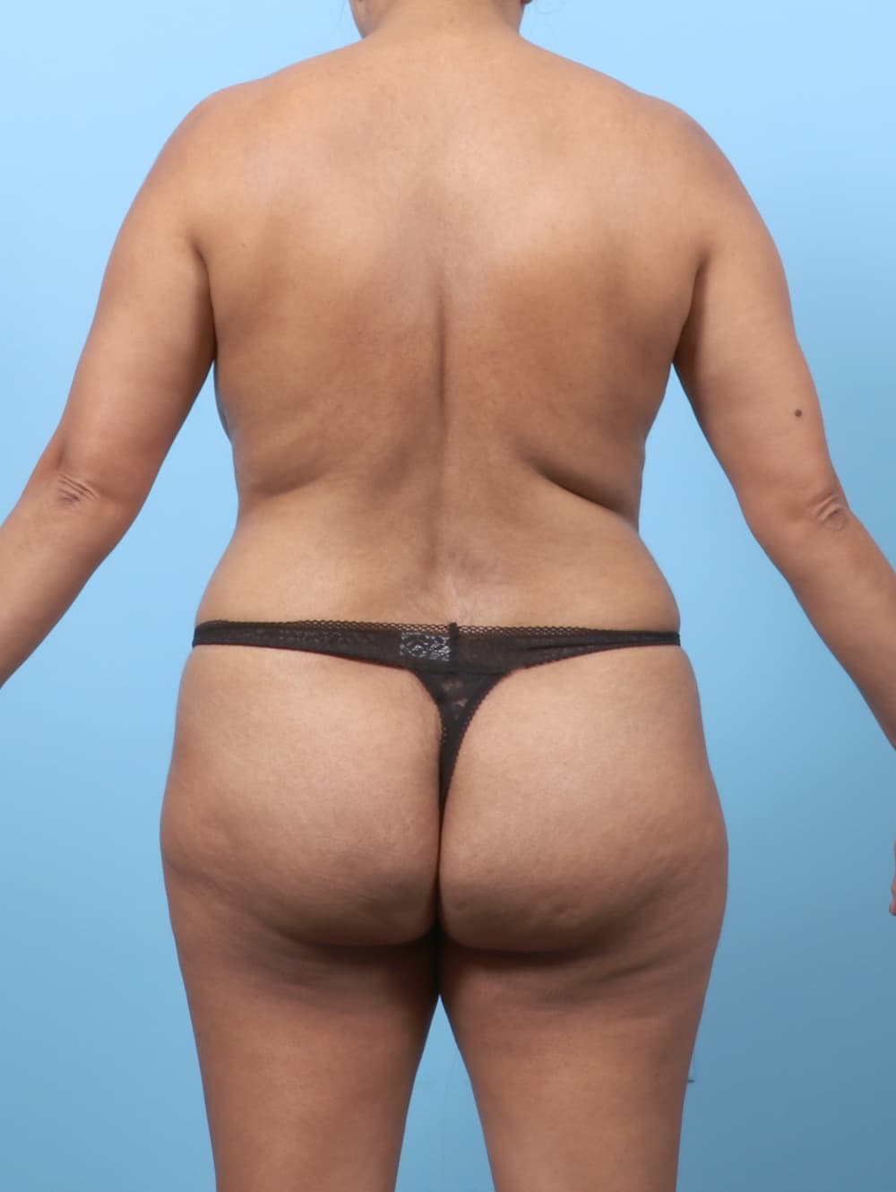 Tummy Tuck case #8978 before, image 4