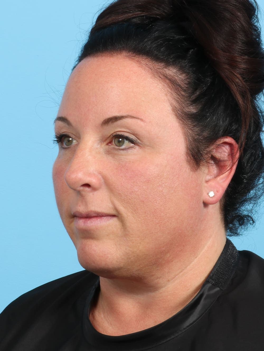 Rhinoplasty case #2671 after, image 3