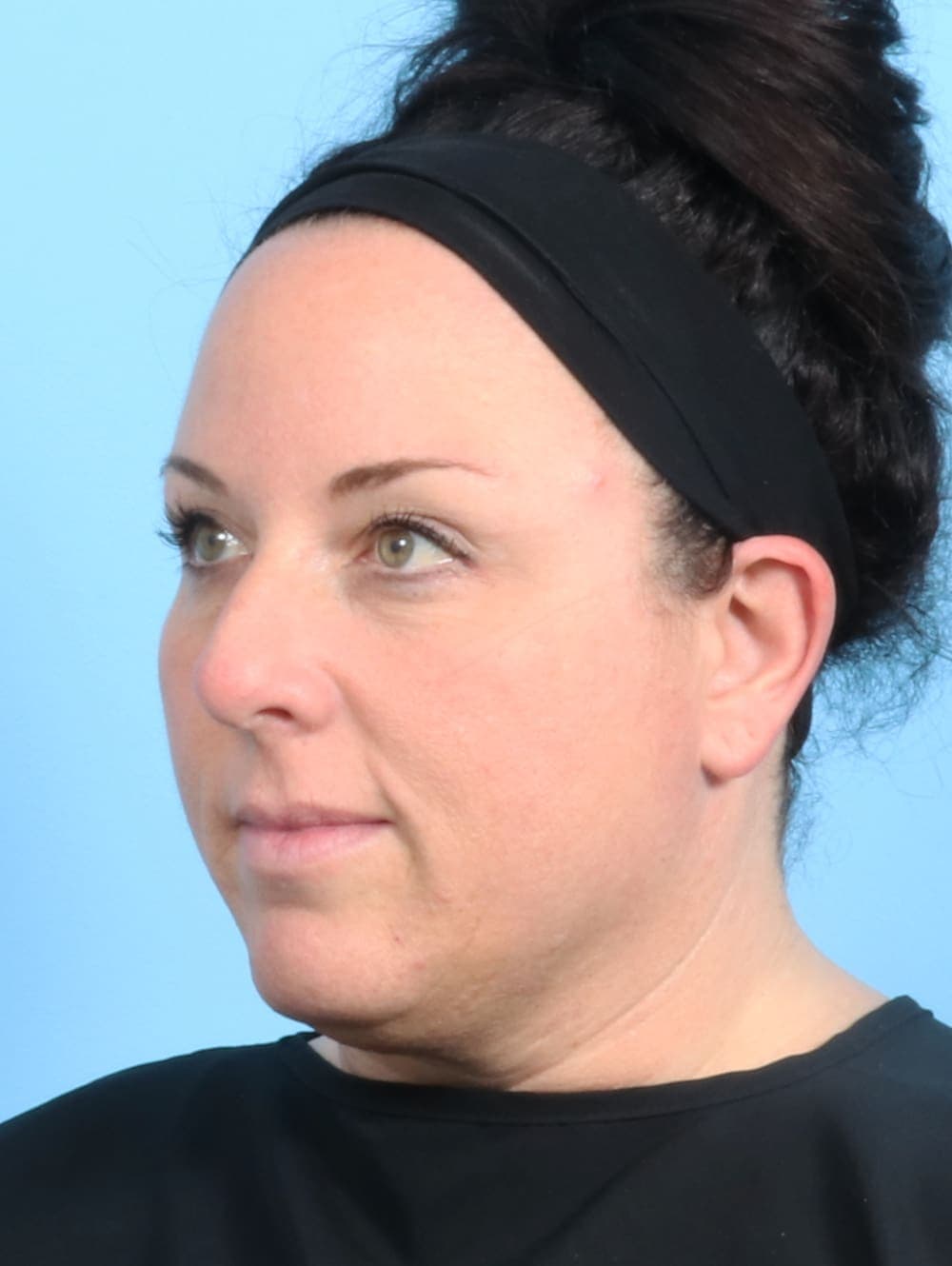 Rhinoplasty case #2671 before, image 3