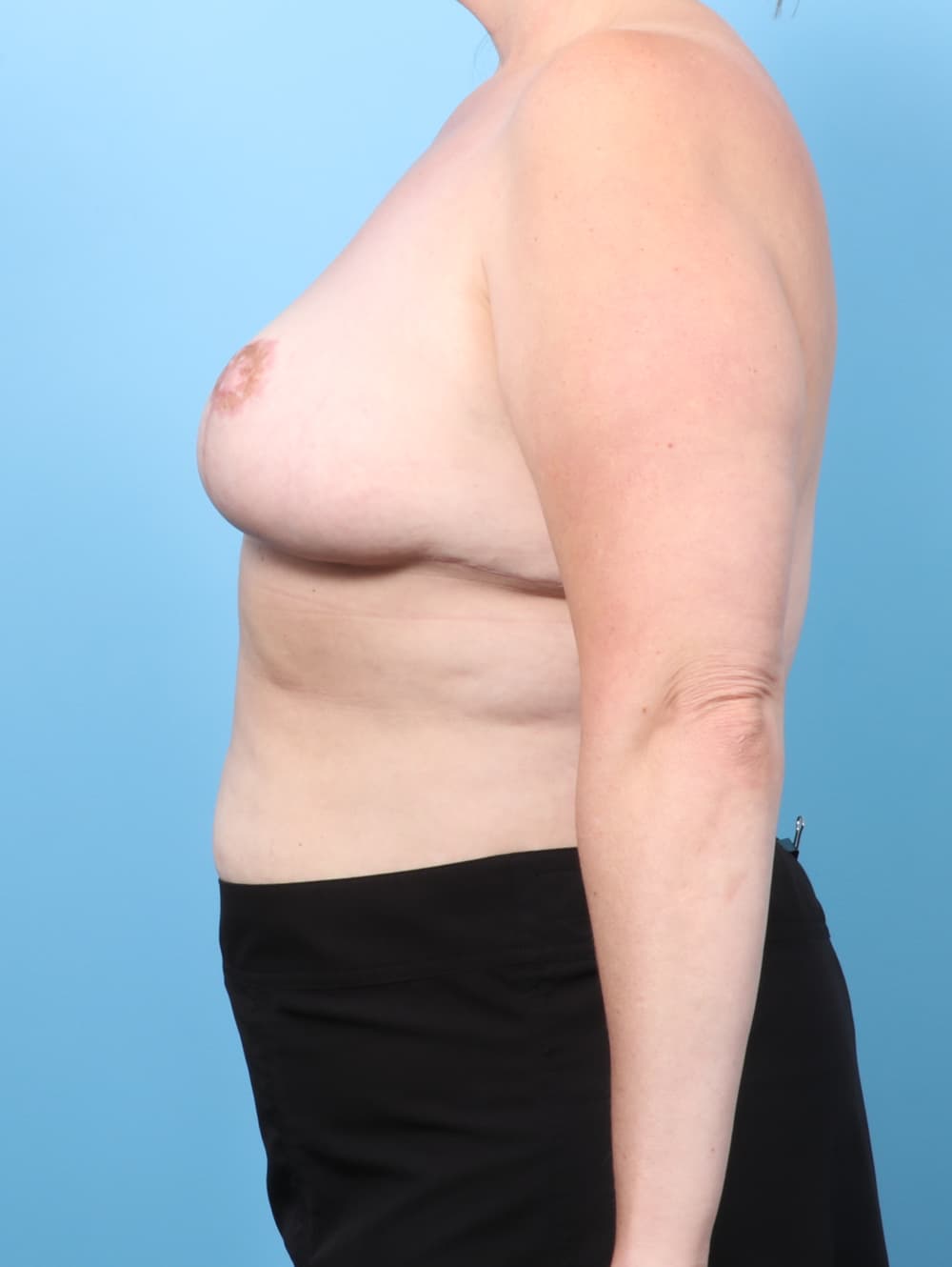 Breast Lift/Reduction case #8618 after, image 3