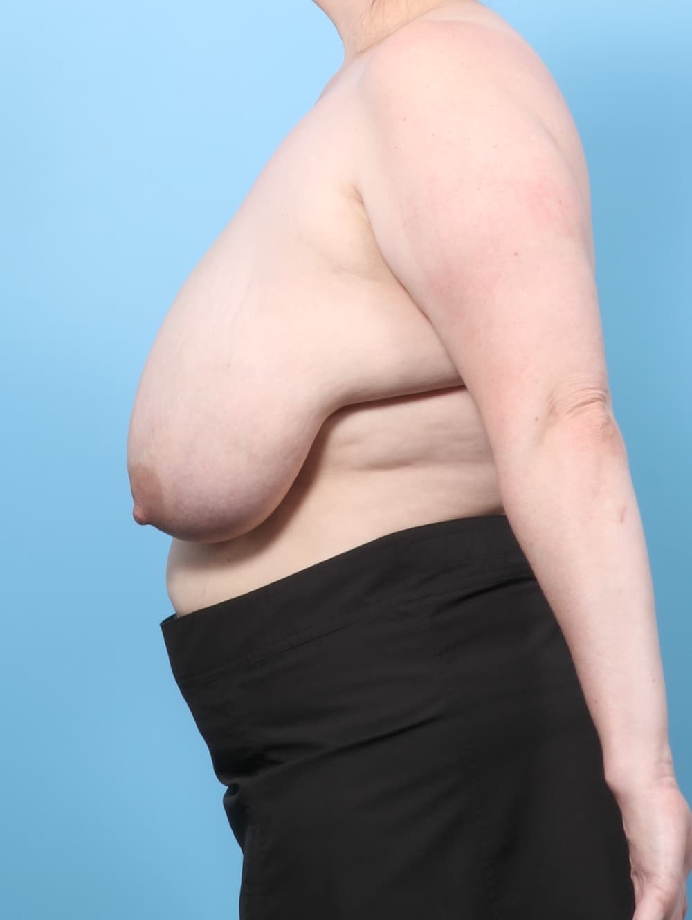 Breast Lift/Reduction case #8618 before, image 3