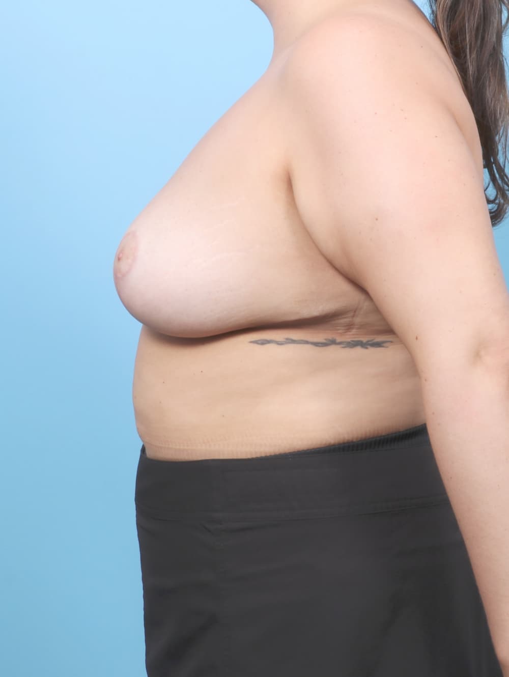 Breast Lift/Reduction case #8237 after, image 3