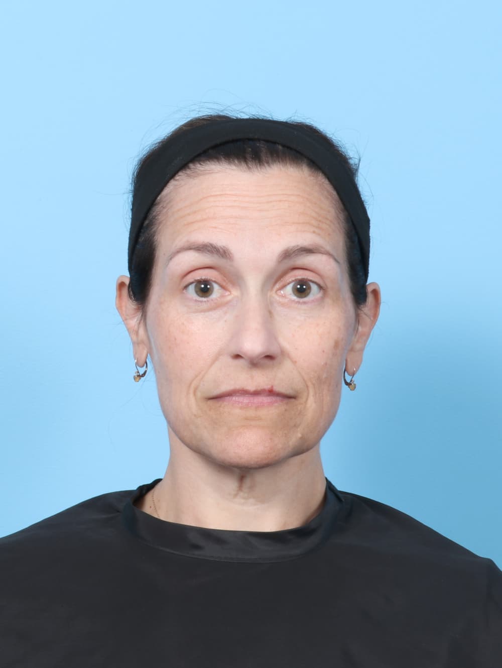 Facelift case #8748 before