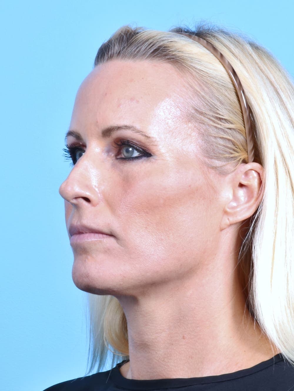 Rhinoplasty case #2655 before, image 3