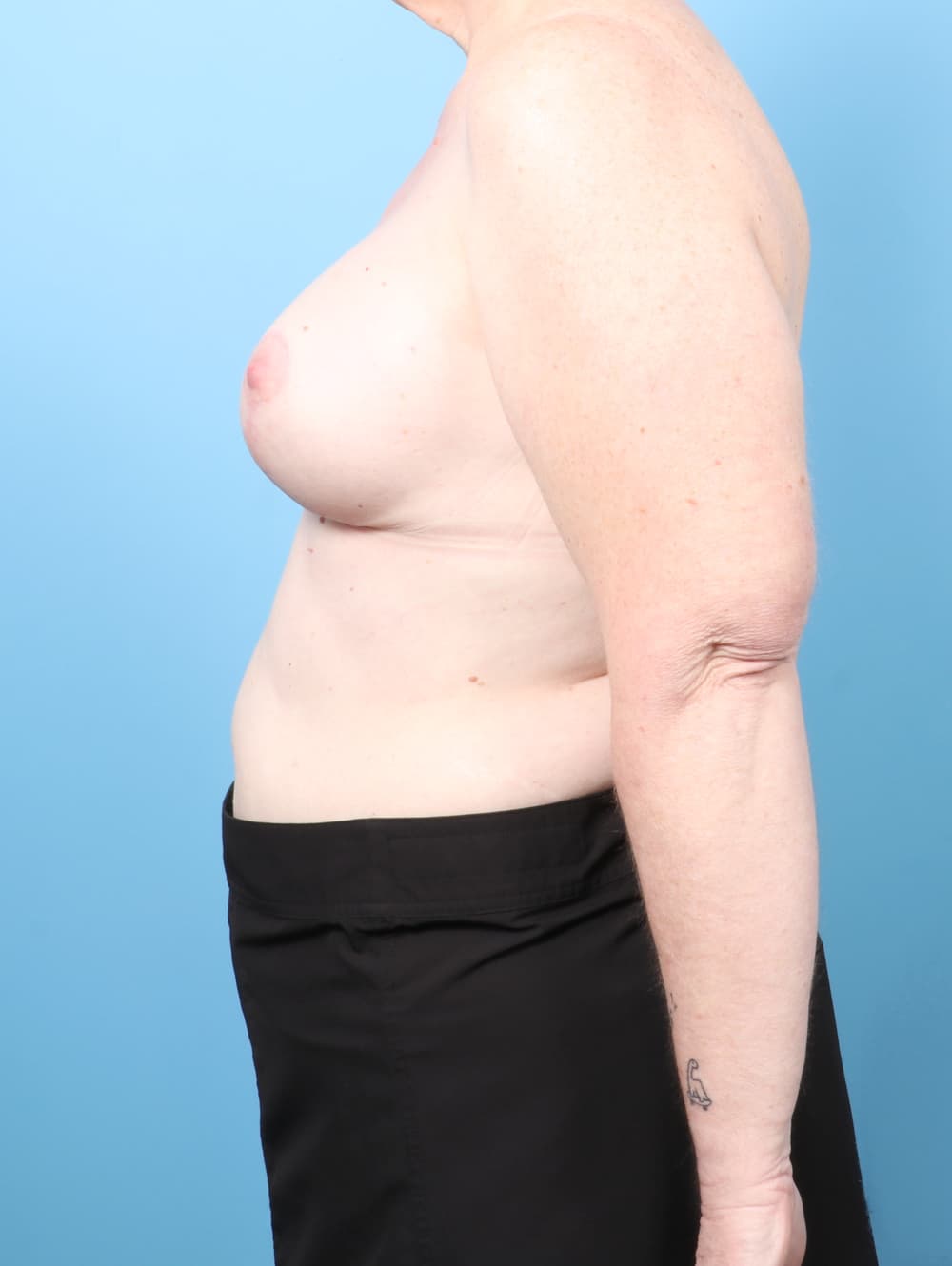 Breast Lift with Implants case #9011 after, image 3