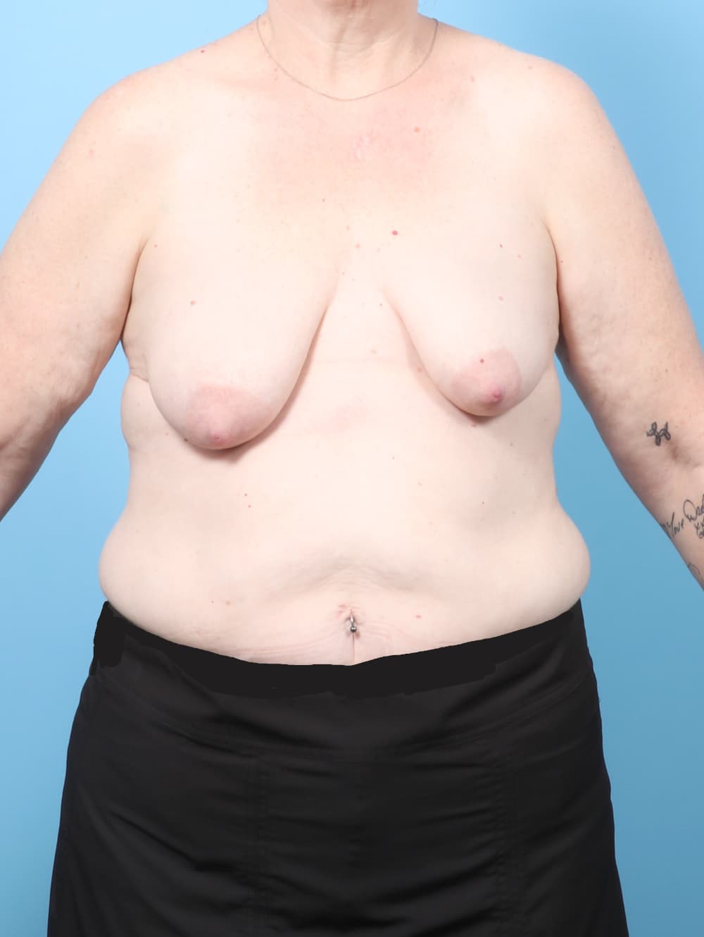 Breast Lift with Implants case #9011 before, image 1