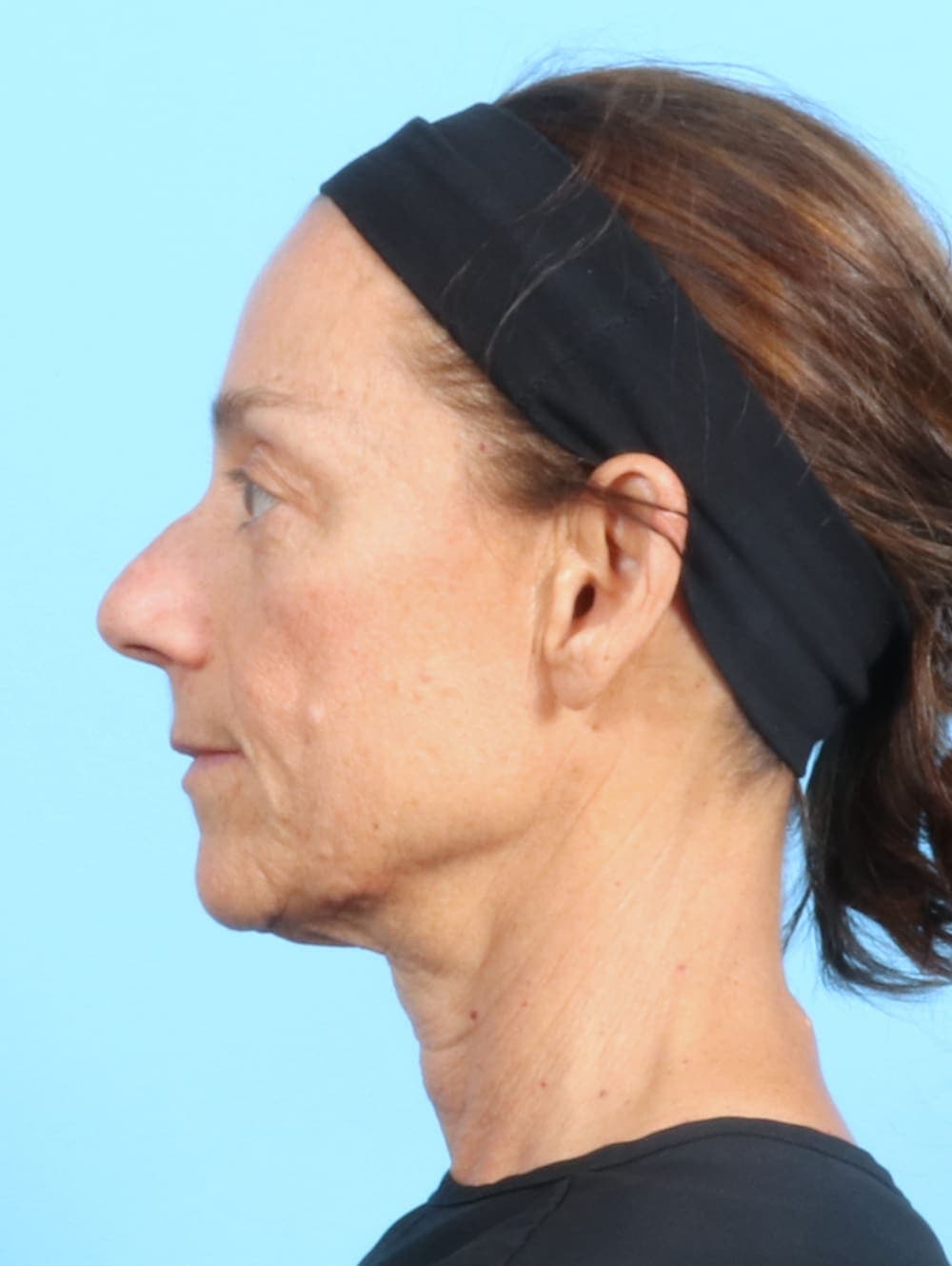 Facelift case #2536 before, image 3