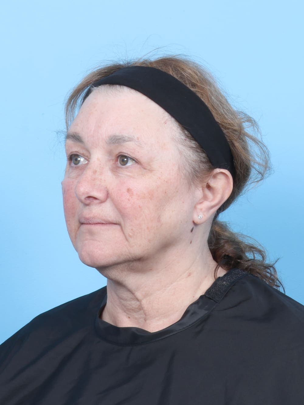 Brow Lift case #6751 after, image 2