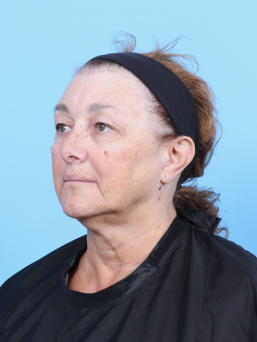 Brow Lift case #6751 before, image 2