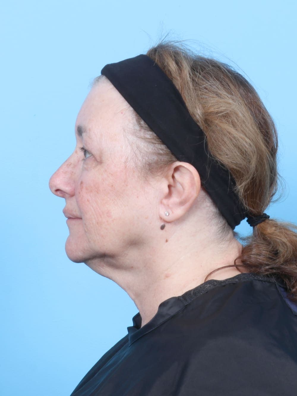 Brow Lift case #6751 after, image 3