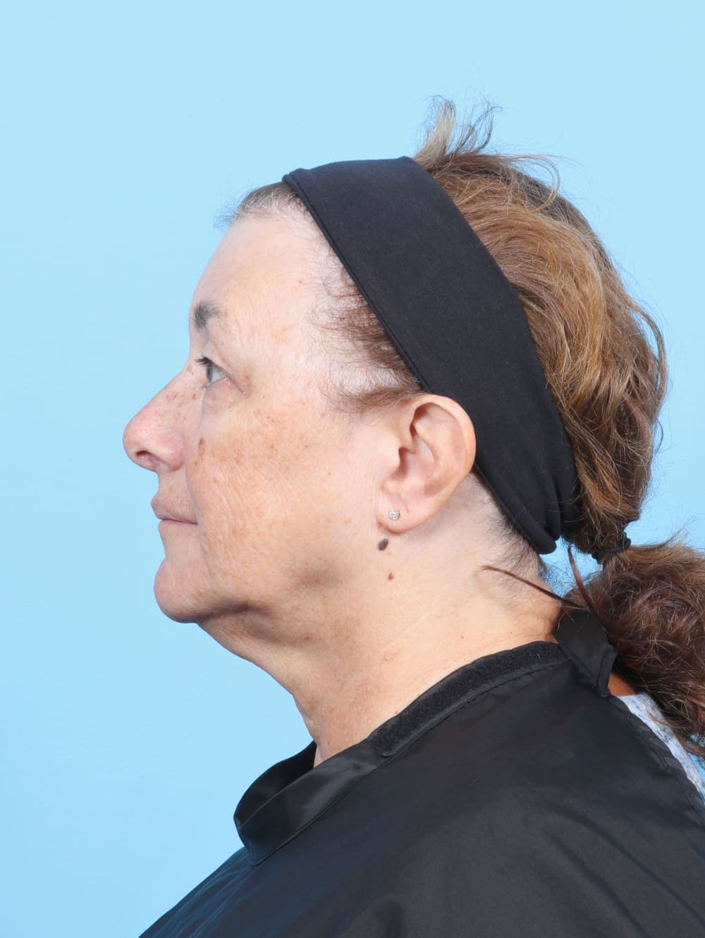 Brow Lift case #6751 before, image 3