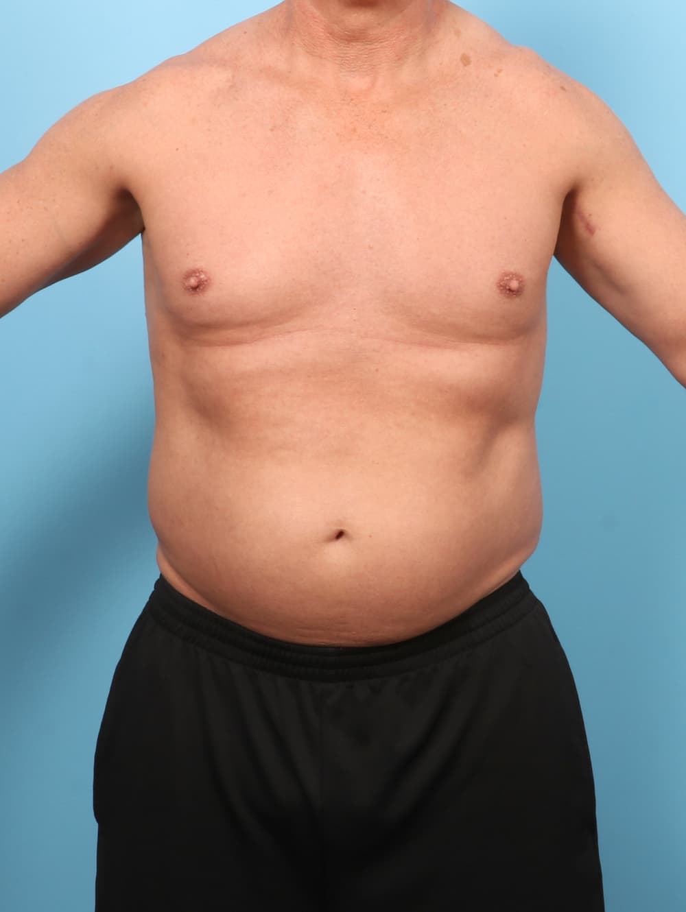Liposuction case #8992 before, image 1