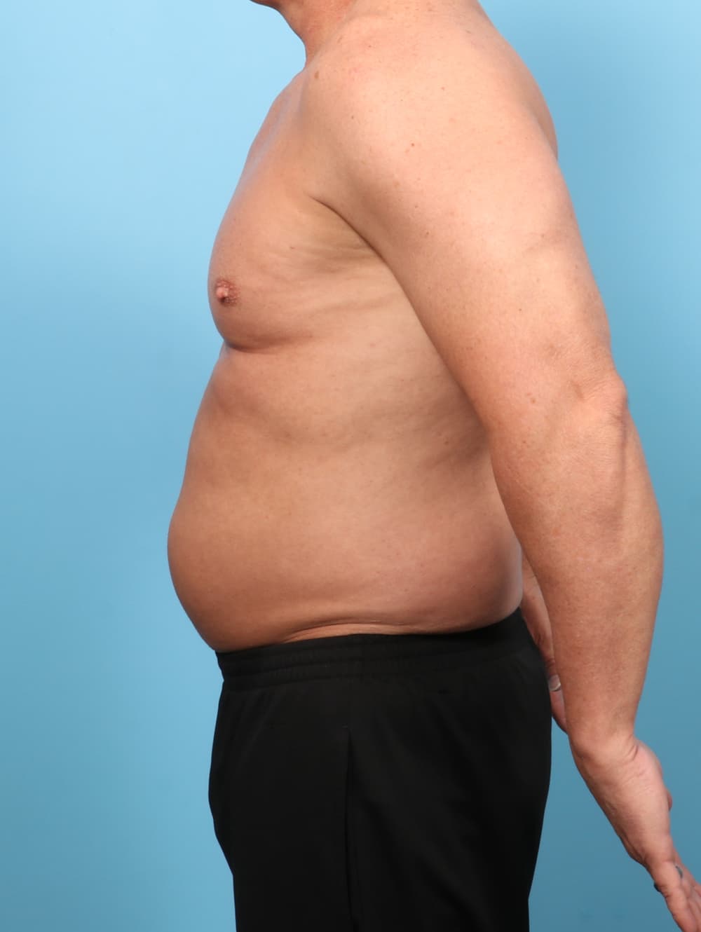 Liposuction case #8992 before, image 3
