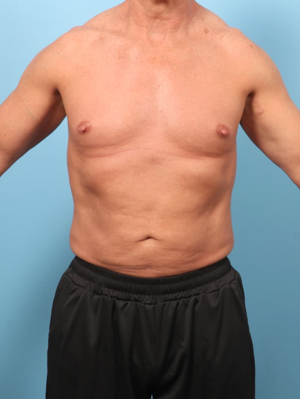 Liposuction case #8992 after, image 1