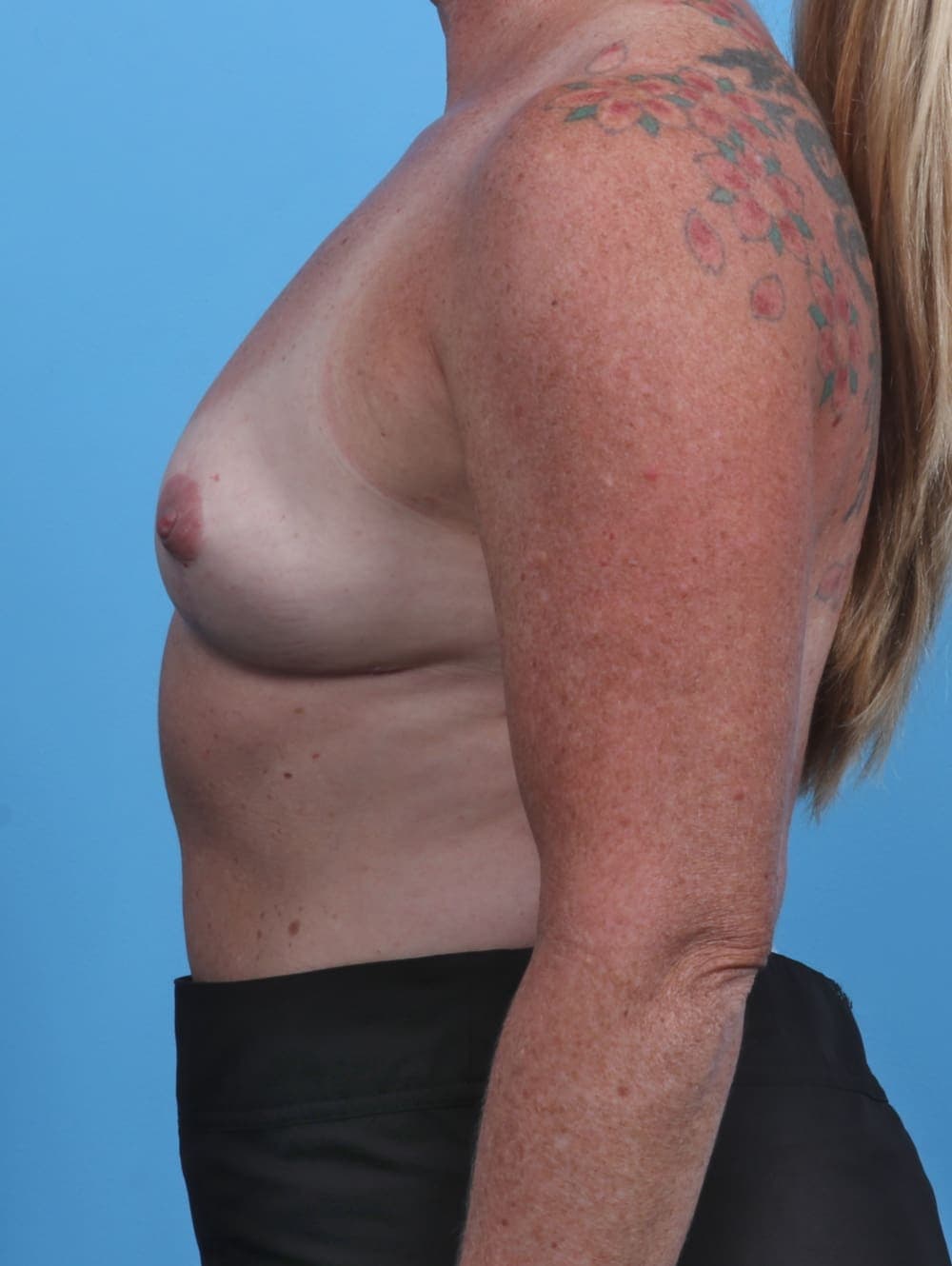 Breast Implant Revision case #3717 after, image 3