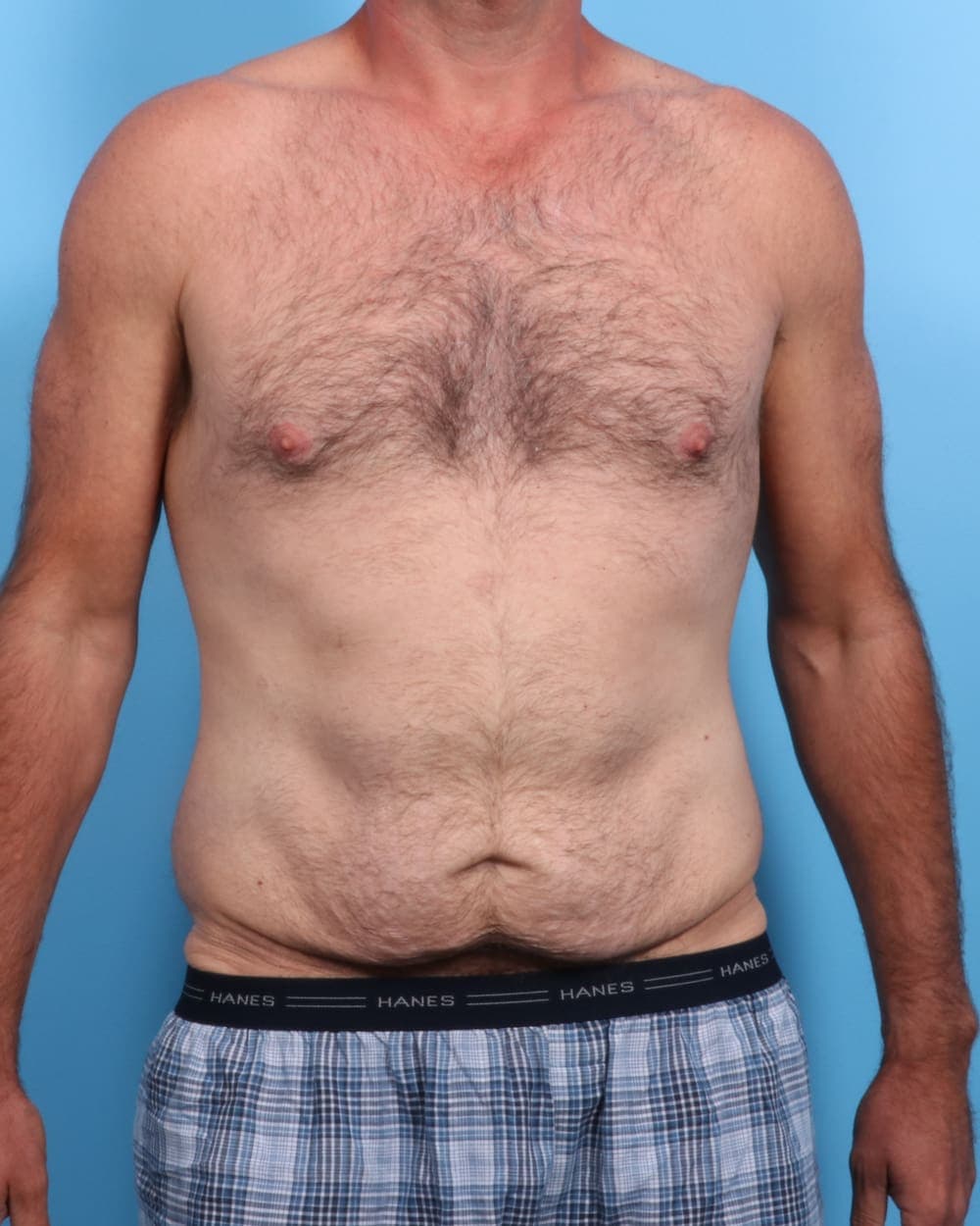Body Lift case #1739 before