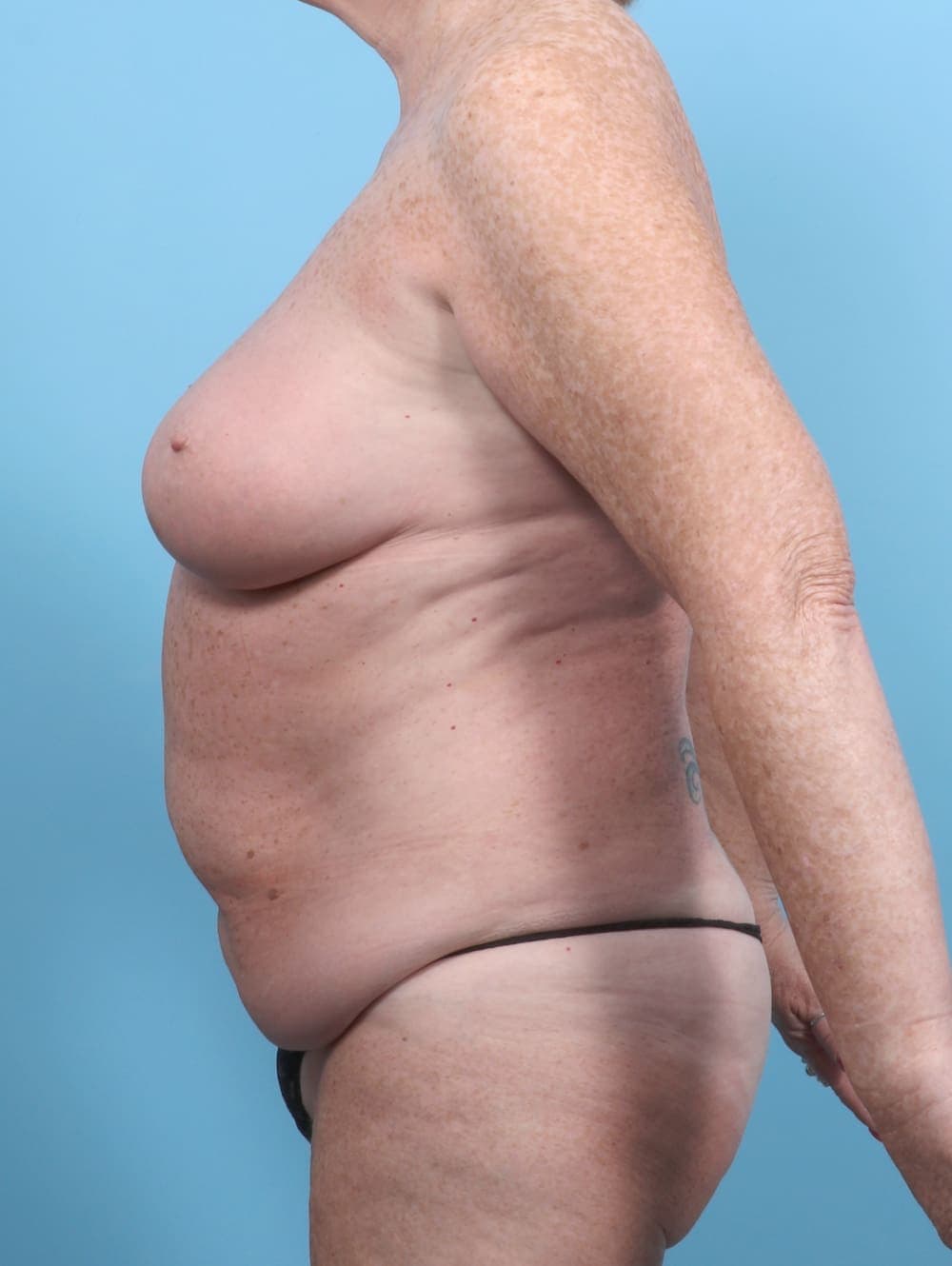 Breast Implant Revision case #6489 before, image 3