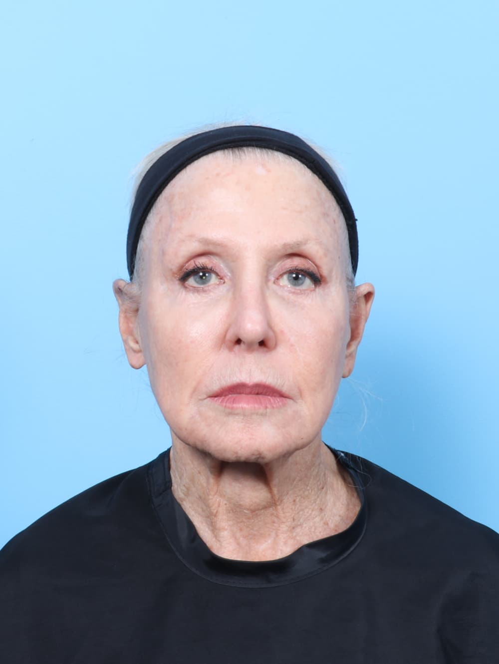 Facelift case #9021 before, image 1