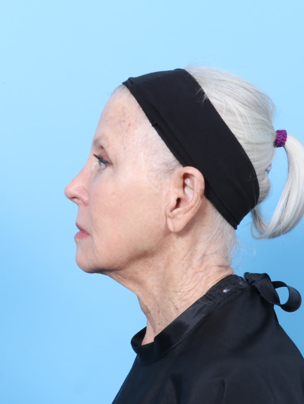 Facelift case #9021 before, image 4