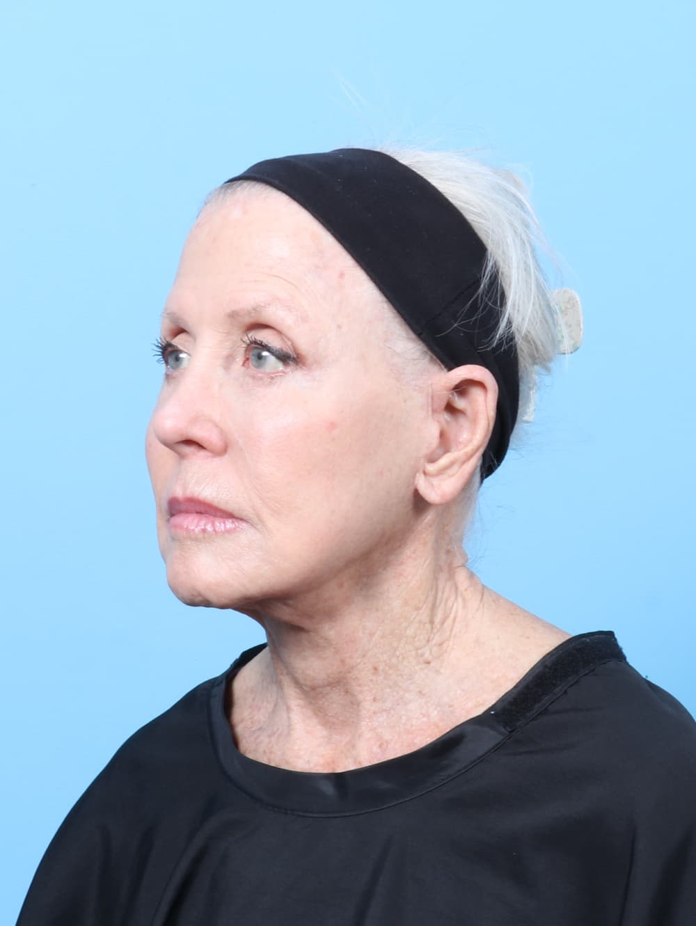 Facelift case #9021 after, image 3