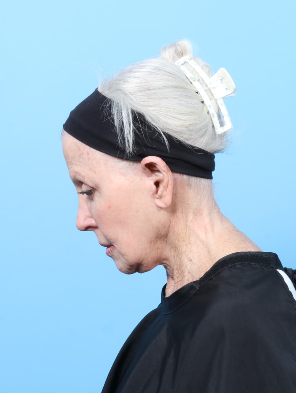 Facelift case #9021 after, image 2