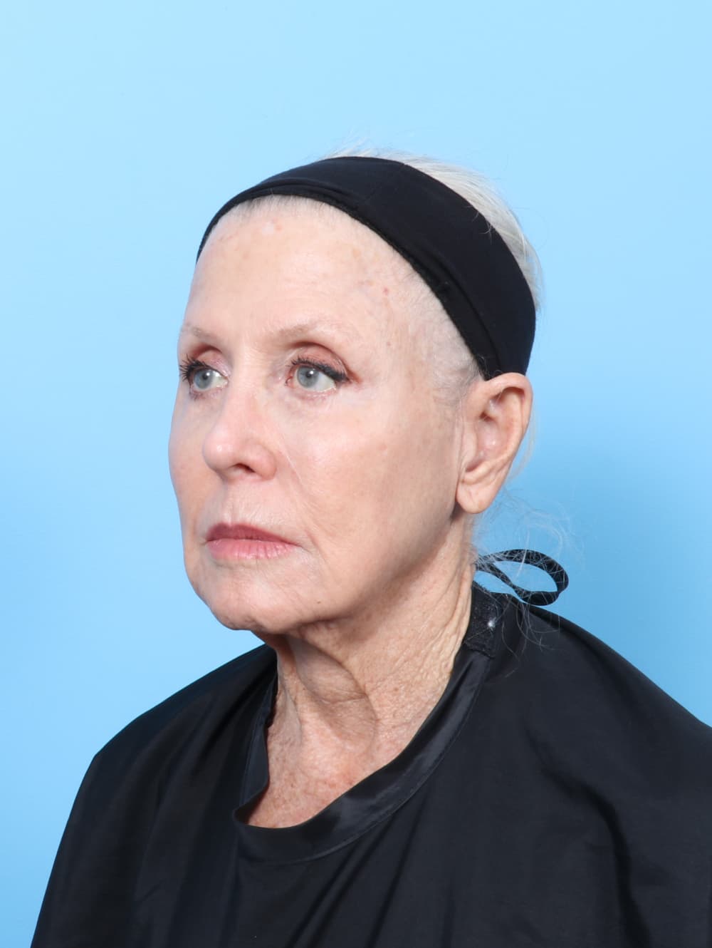 Facelift case #9021 before, image 3