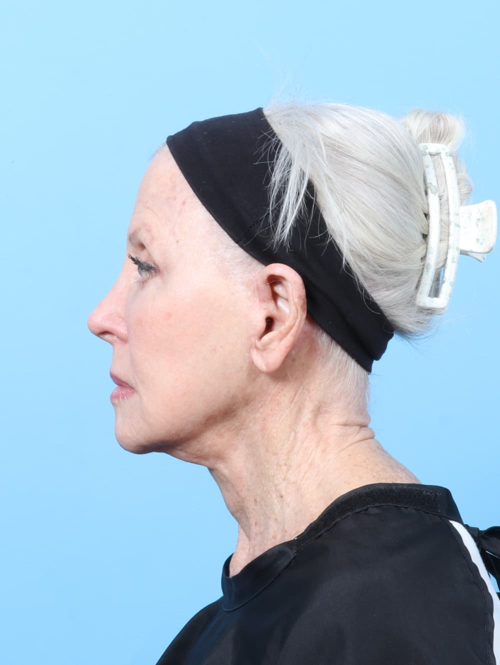 Facelift case #9021 after, image 4