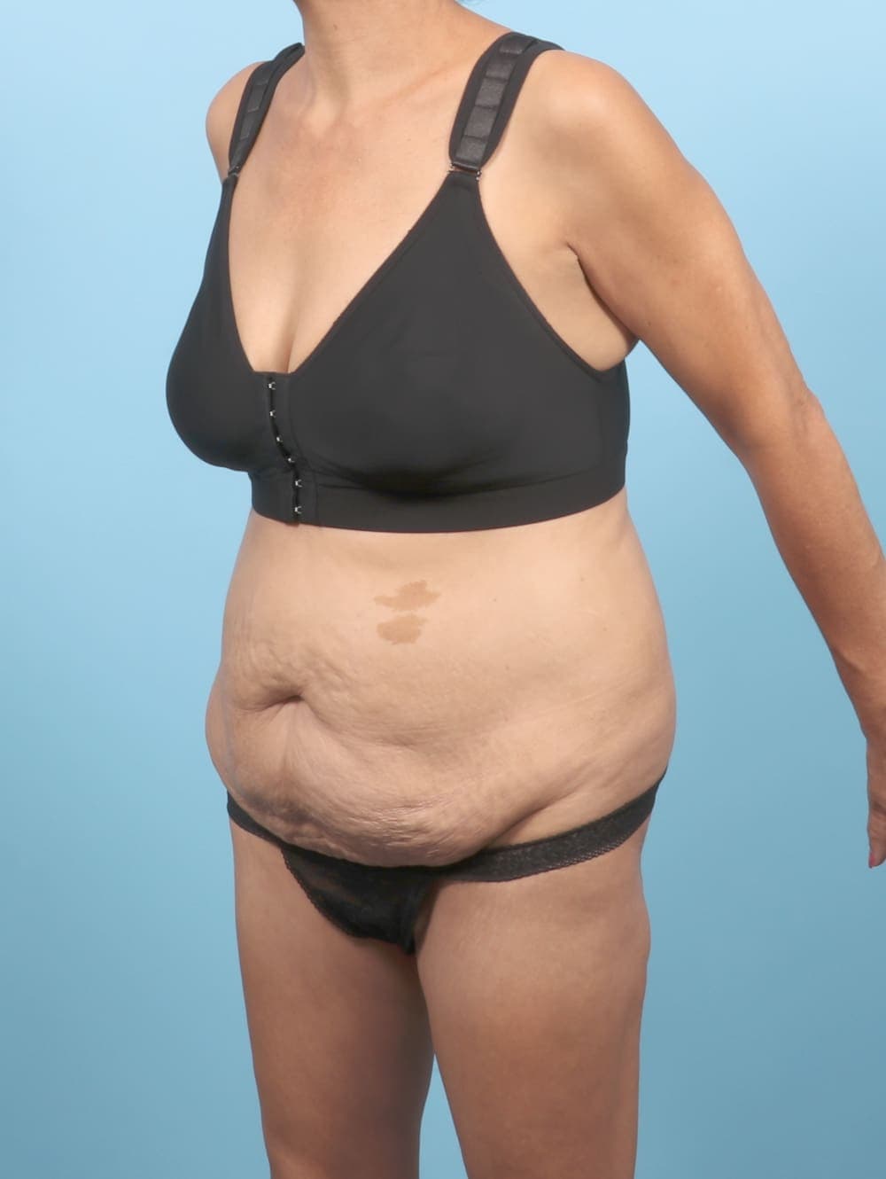 Liposuction case #6651 before, image 2