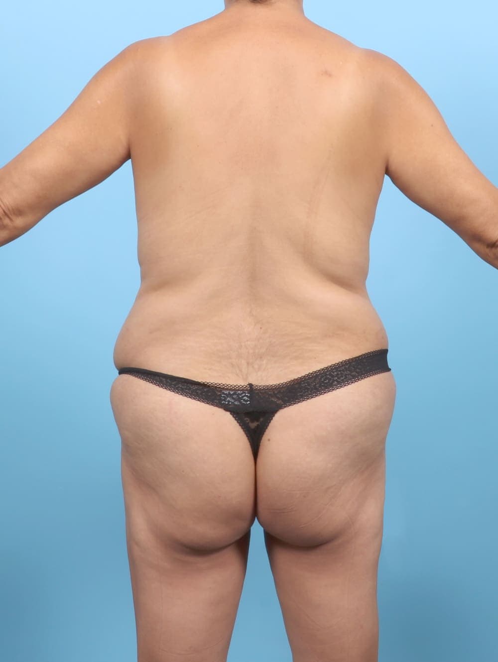 Liposuction case #6651 before, image 4