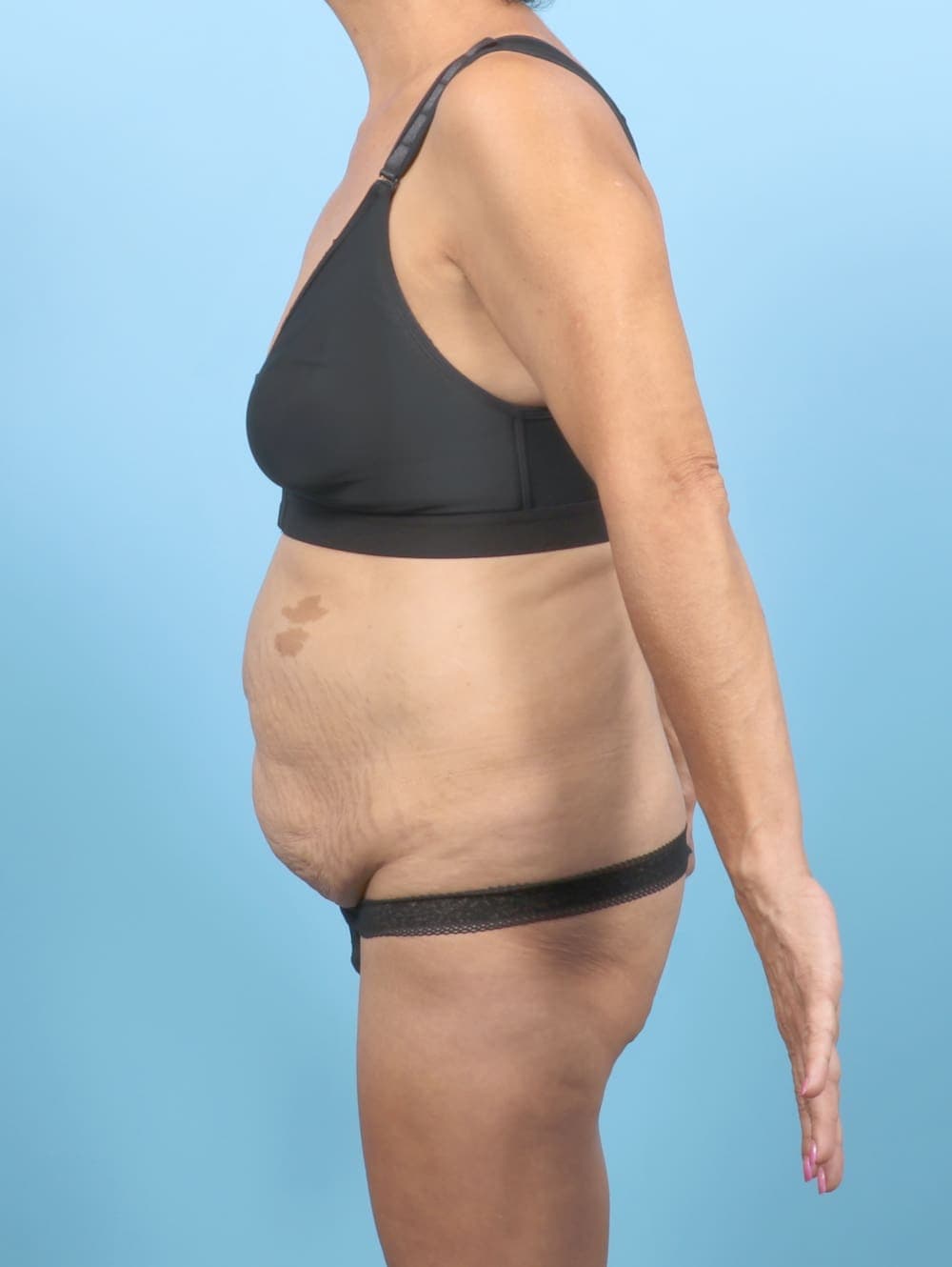 Liposuction case #6651 before, image 3