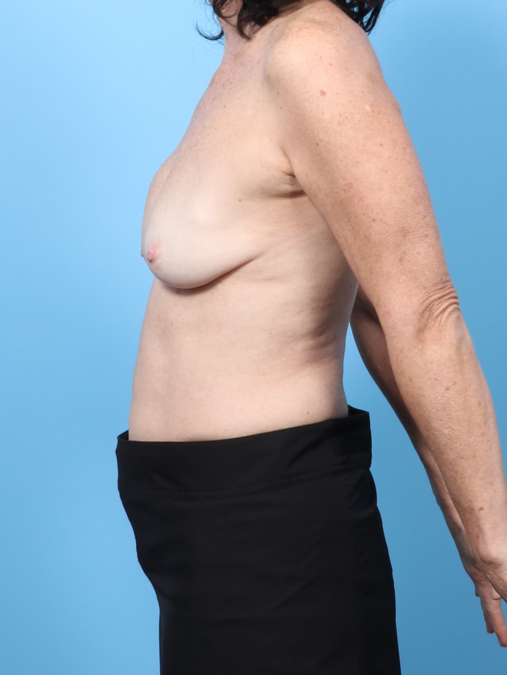 Breast Implant Removal with Lift case #9027 before, image 3