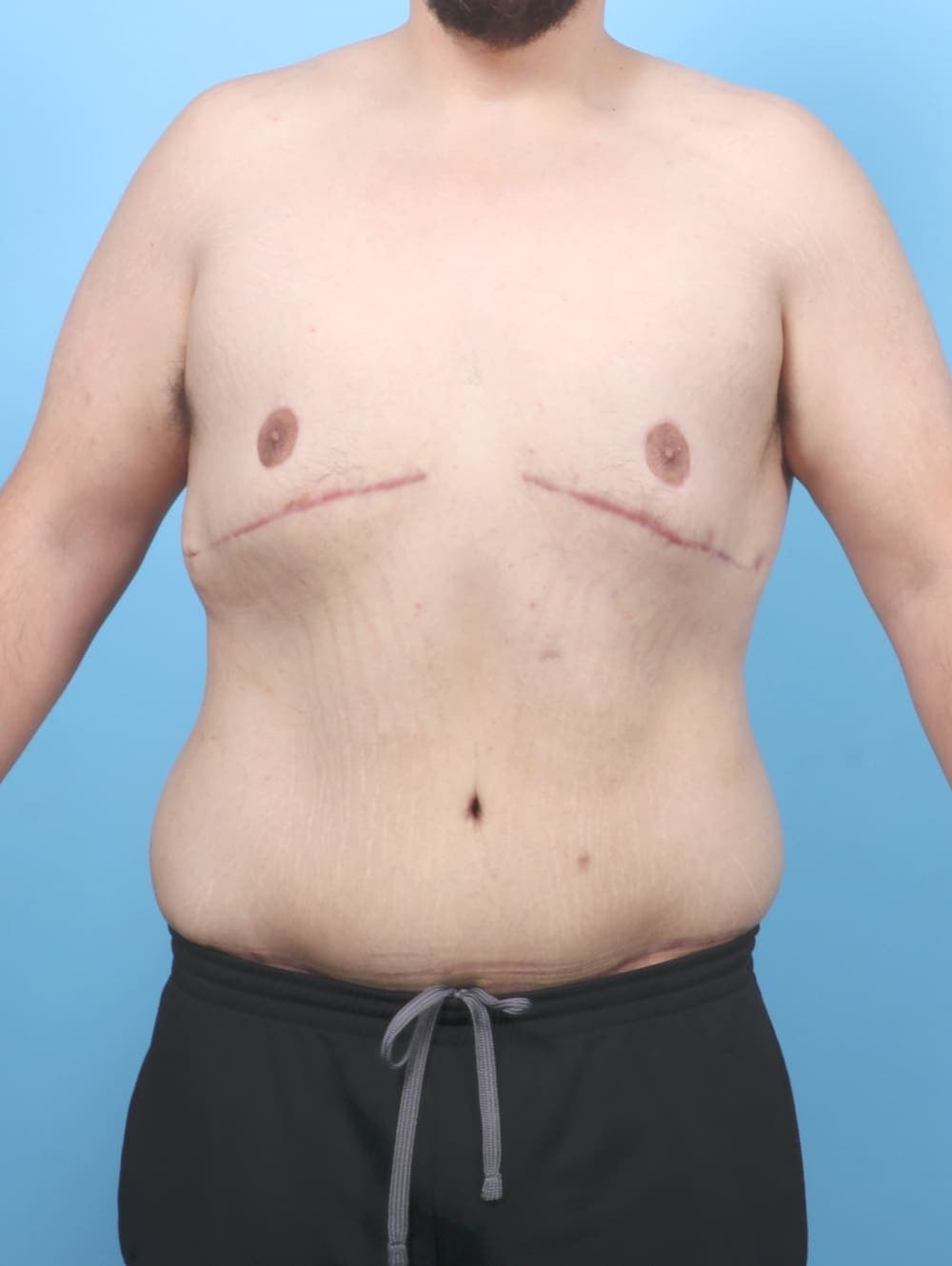 Body Lift case #6417 after