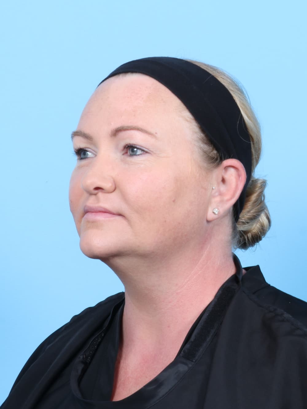 Facial Liposuction case #6998 after, image 2