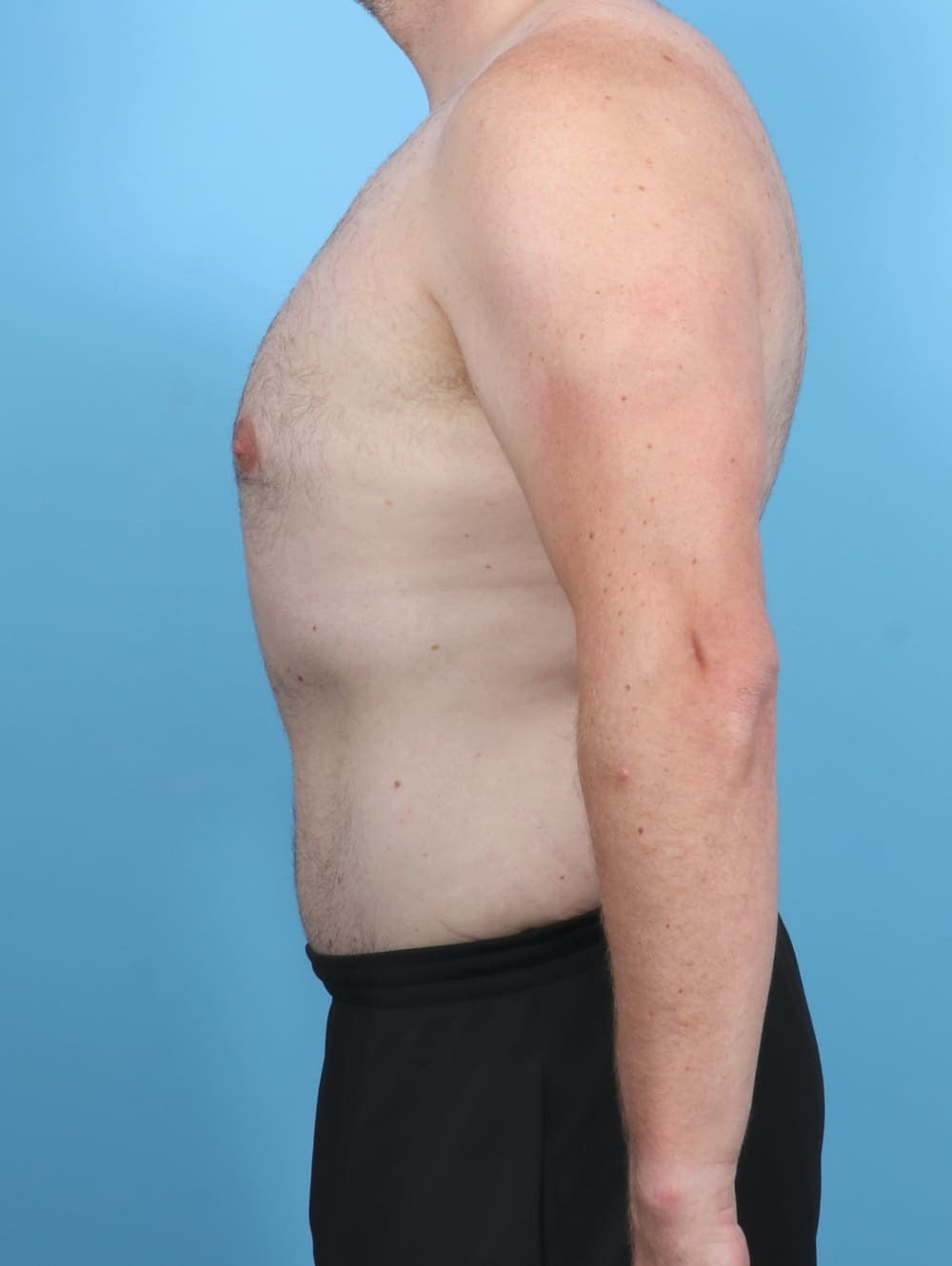 Liposuction case #5542 after, image 4