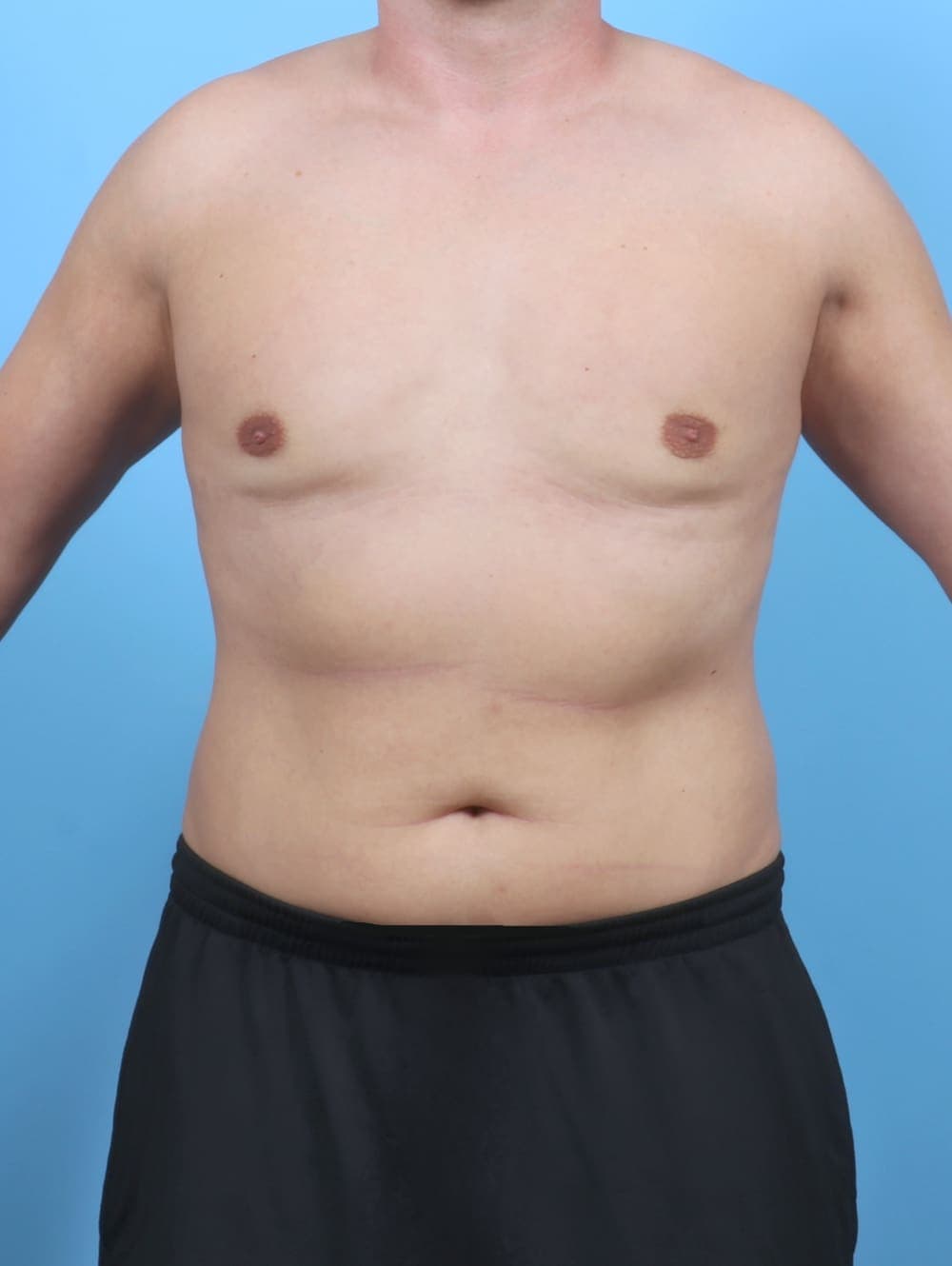 Male Breast Reduction case #5873 after