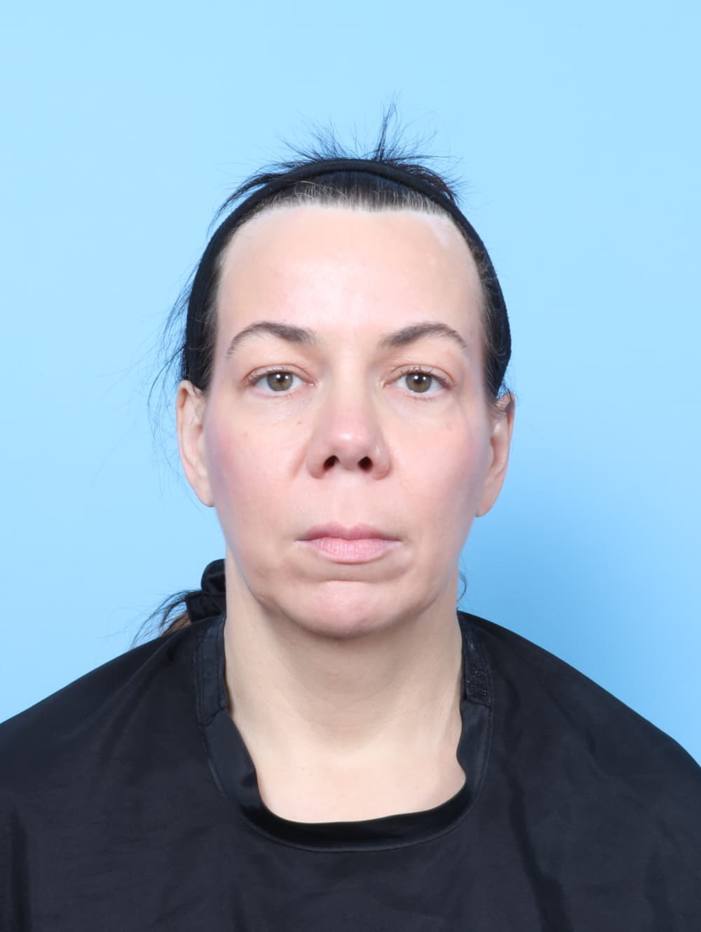 Eyelid Surgery case #9014 before, image 1