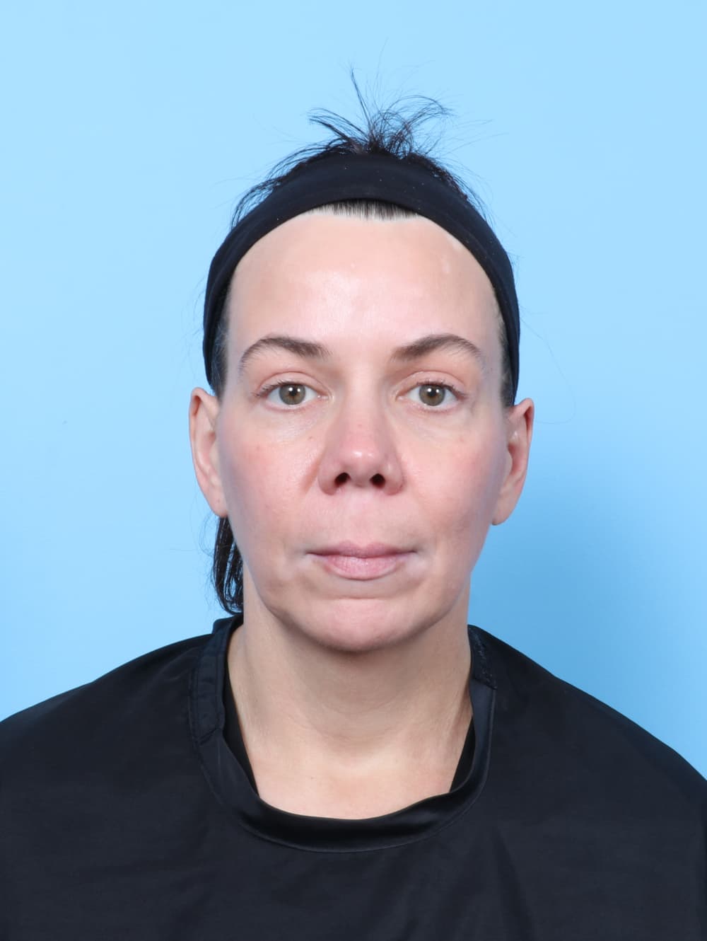 Eyelid Surgery case #9014 after, image 1
