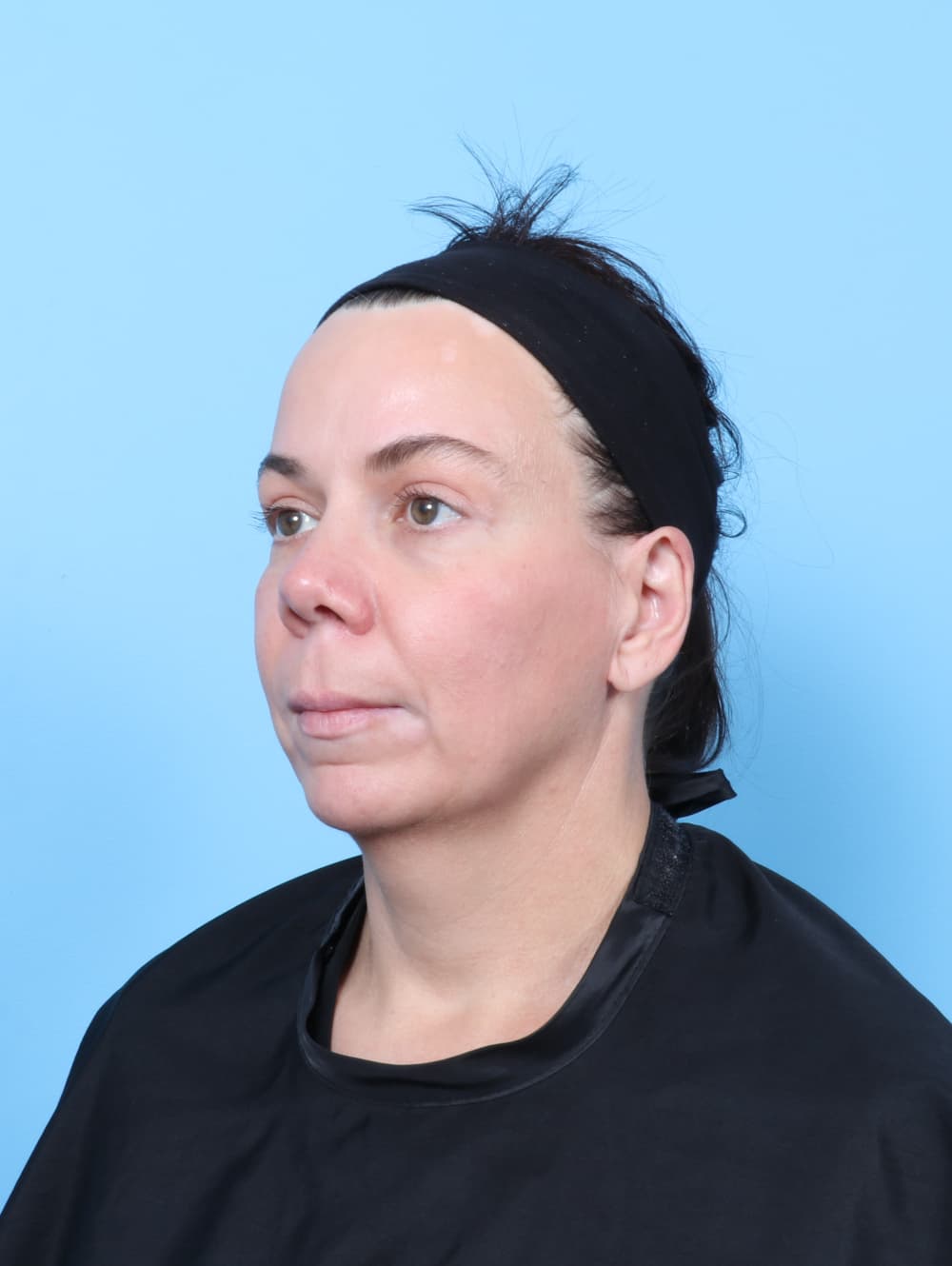 Eyelid Surgery case #9014 after, image 2