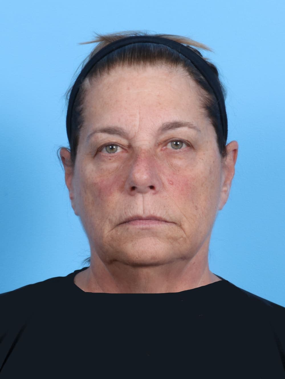Facelift case #1973 before